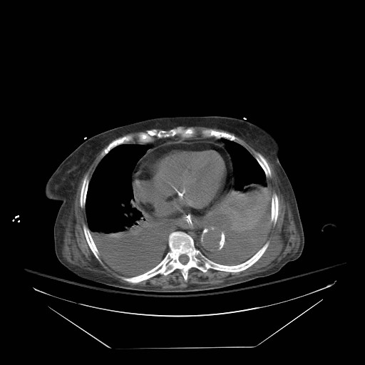 Abdominal aortic aneurysm - impending rupture (Radiopaedia 19233-19247 Axial non-contrast 20).jpg