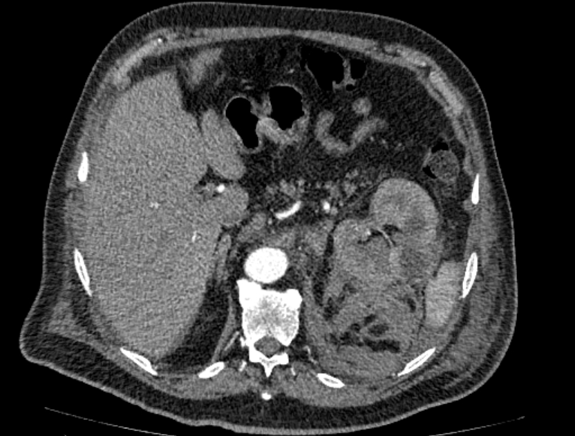 Abdominal aortic aneurysm rupture (Radiopaedia 54179-60362 Axial C+ arterial phase 23).jpg