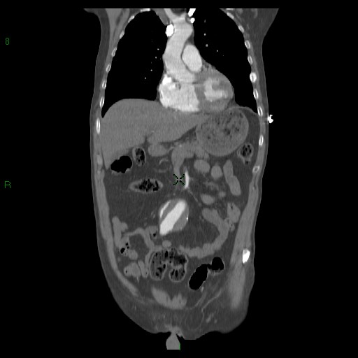 File:Abdominal aortic aneurysm rupture with aortocaval fistula (Radiopaedia 14897-14841 Coronal C+ arterial phase 20).jpg
