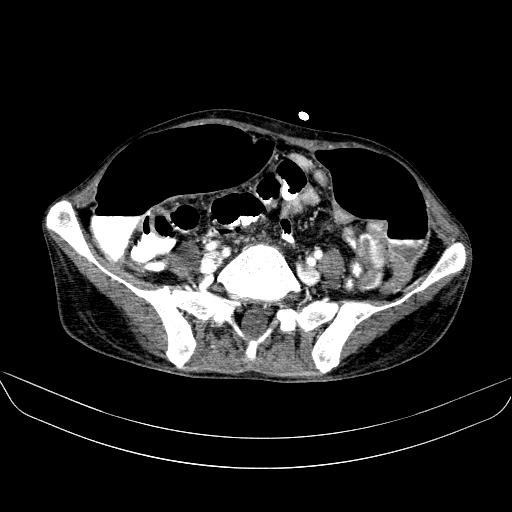 File:Abdominal collection due to previous cecal perforation (Radiopaedia 80831-94320 Axial C+ portal venous phase 142).jpg