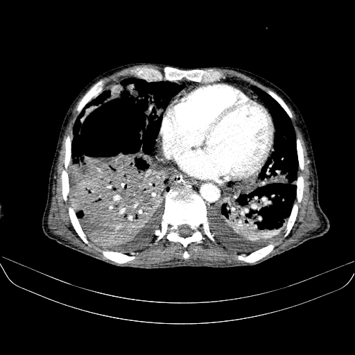 File:Abdominal collection due to previous cecal perforation (Radiopaedia 80831-94320 Axial C+ portal venous phase 3).jpg