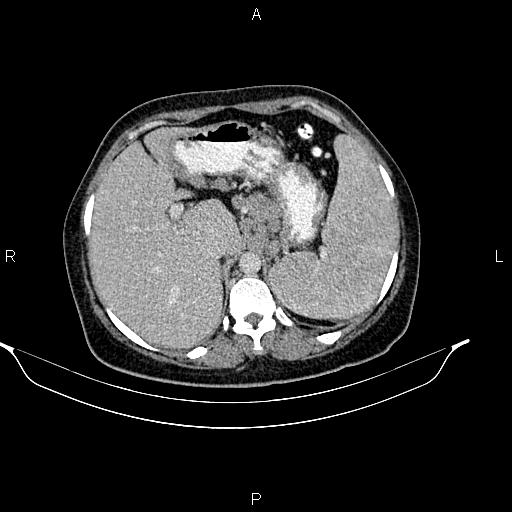 Abdominal lymphoma with sandwich sign (Radiopaedia 84378-99704 Axial C+ portal venous phase 13).jpg