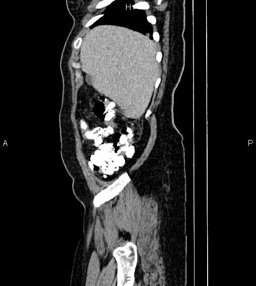 File:Abdominal lymphoma with sandwich sign (Radiopaedia 84378-99704 Sagittal C+ portal venous phase 5).jpg