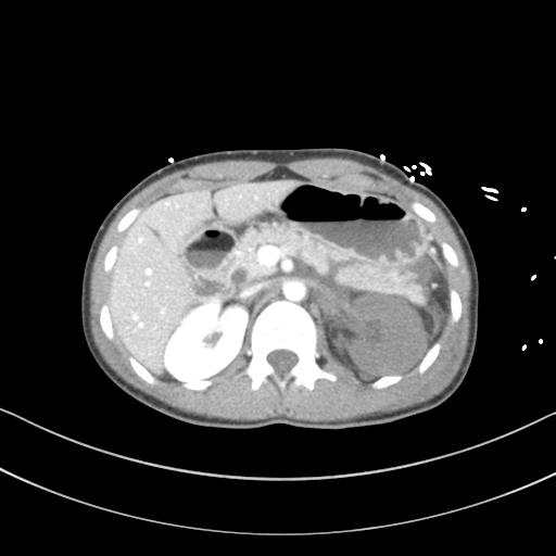 File:Abdominal multi-trauma - devascularised kidney and liver, spleen and pancreatic lacerations (Radiopaedia 34984-36486 Axial C+ portal venous phase 27).png