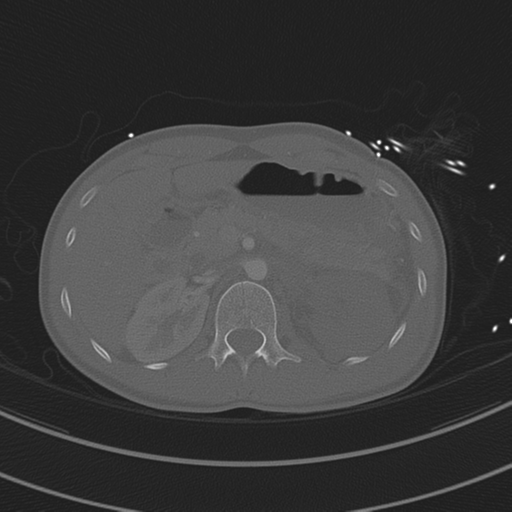 Abdominal multi-trauma - devascularised kidney and liver, spleen and pancreatic lacerations (Radiopaedia 34984-36486 I 101).png