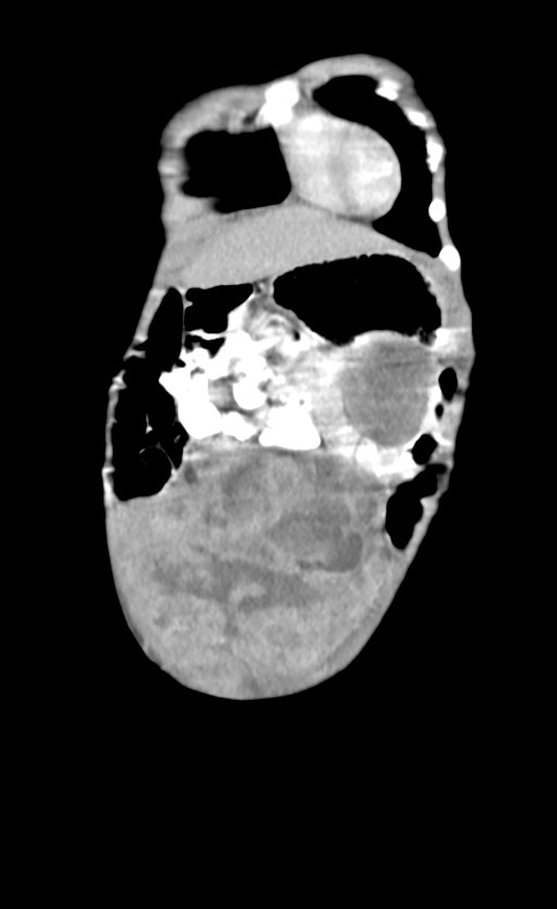 Abdominopelvic rhabdomyosarcoma (Radiopaedia 78356-90984 Coronal C+ portal venous phase 15).jpg