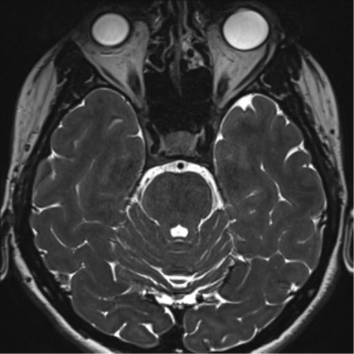 Abducens nerve palsy (Radiopaedia 51069-56648 Axial T2 fat sat 45).png