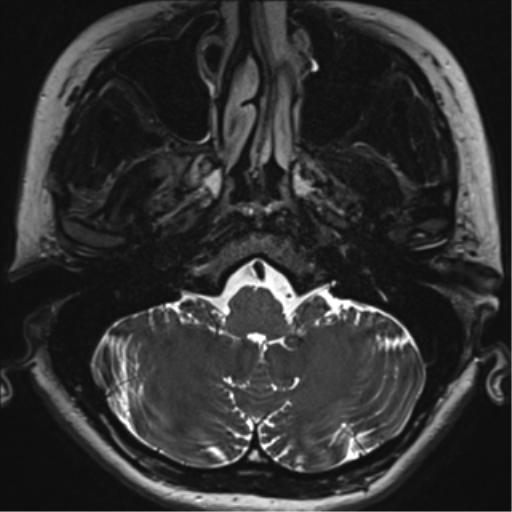 Abducens nerve palsy (Radiopaedia 51069-56648 Axial T2 fat sat 5).png