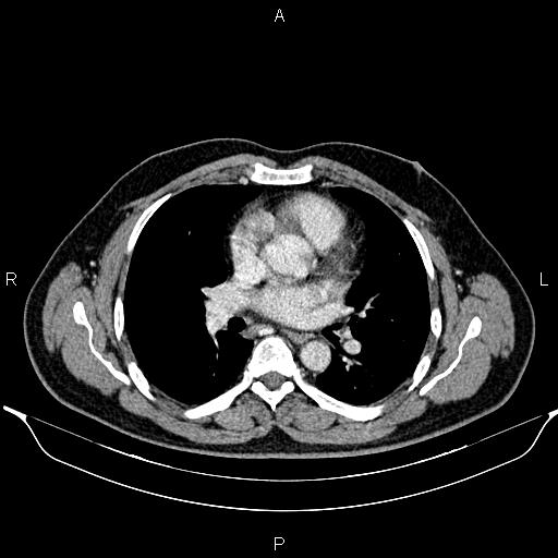 File:Aberrant right subclavian artery (Radiopaedia 87093-103354 Axial With contrast 57).jpg