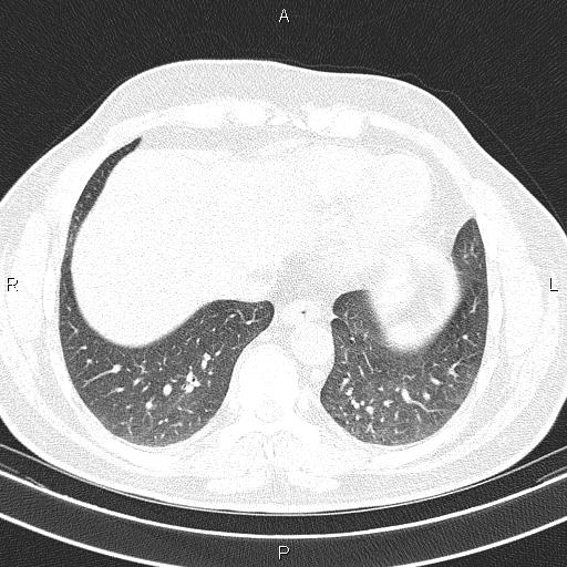 Aberrant right subclavian artery (Radiopaedia 87093-103354 Axial lung window 85).jpg