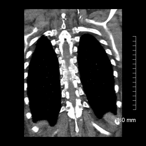 Aberrant right subclavian artery stenosis (Radiopaedia 52656-58670 B 70).jpg