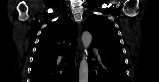 Accesory rib joint (Radiopaedia 71987-82452 Coronal bone window 2).jpg