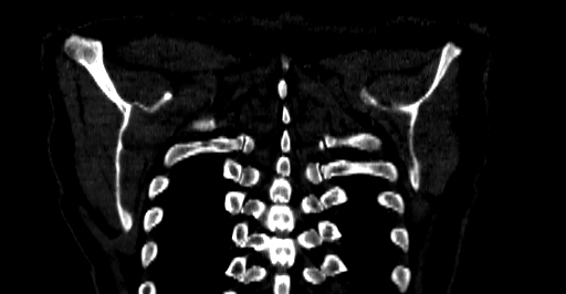 Accesory rib joint (Radiopaedia 71987-82452 Coronal bone window 77).jpg