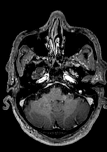 Accessory middle cerebral artery (Radiopaedia 73114-83828 Axial T1 C+ 137).jpg