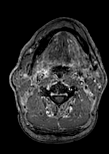 Accessory middle cerebral artery (Radiopaedia 73114-83828 Axial T1 C+ 296).jpg
