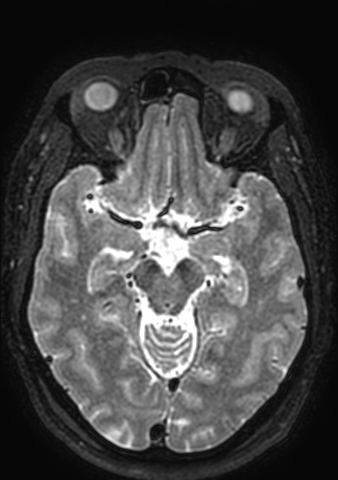 Accessory middle cerebral artery (Radiopaedia 73114-83828 Axial T2 111).jpg