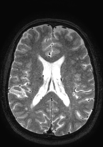 Accessory middle cerebral artery (Radiopaedia 73114-83828 Axial T2 38).jpg