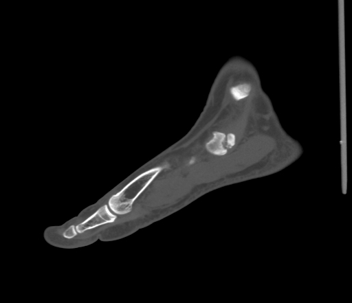 File:Accessory navicular bone (Radiopaedia 54999-61314 Sagittal non-contrast 25).jpg