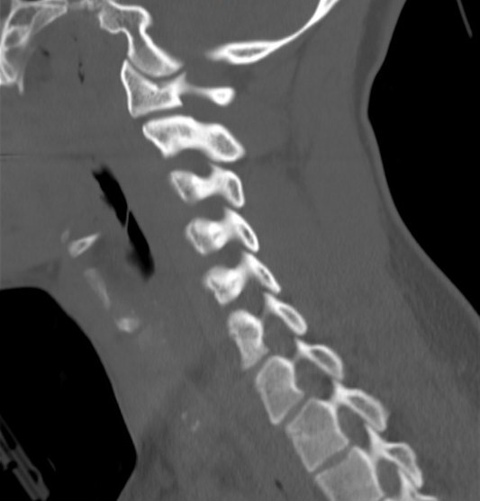 File:Accessory ossicle of the anterior arch of C1 vertebra (Radiopaedia 58149-65211 Sagittal bone window 13).jpg