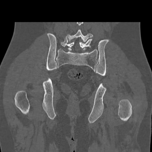 Acetabular and ilial fractures (Radiopaedia 59084-66378 Coronal bone window 39).jpg