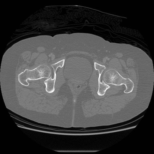File:Acetabular fracture (Radiopaedia 13193-13212 Axial bone window 39).jpg