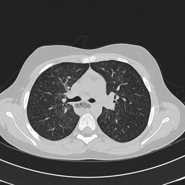 Achalasia (Radiopaedia 14946-14878 Axial lung window 27).jpg