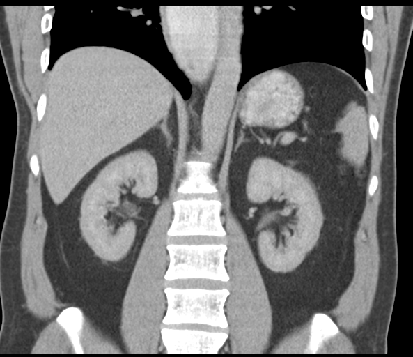 File:Achalasia of the cardia (Radiopaedia 38497-40595 Coronal C+ portal venous phase 33).png