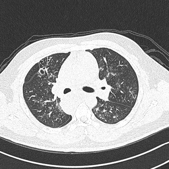 Achalasia with aspiration (Radiopaedia 55413-61845 Axial lung window 29).jpg