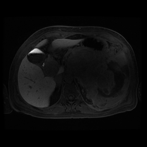 Acinar cell carcinoma of the pancreas (Radiopaedia 75442-86668 Axial late phase (~30 mins) 80).jpg