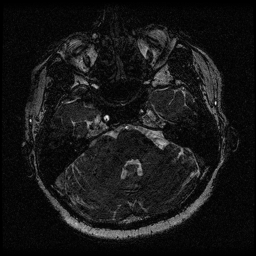File:Acoustic schwannoma (Radiopaedia 33045-34060 Axial T2 32).png