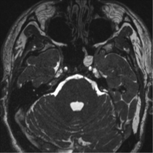 Acoustic schwannoma (translabyrinthine resection) (Radiopaedia 43570-46972 Axial CISS 37).png