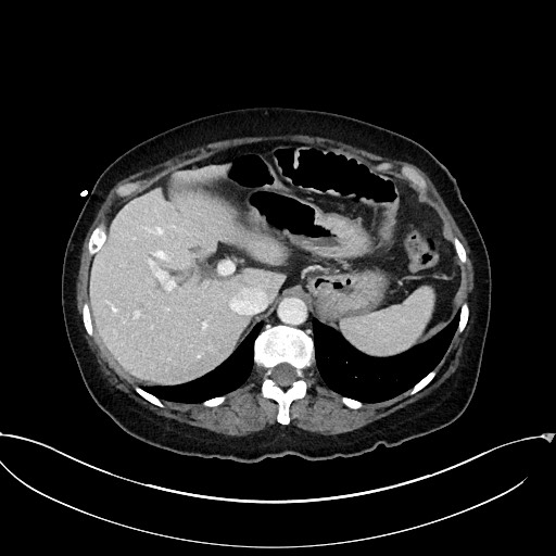 Active Crohn disease (Radiopaedia 59394-66750 Axial C+ portal venous phase 17).jpg