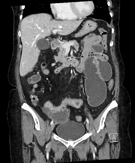 Active Crohn disease (Radiopaedia 59394-66750 Coronal C+ portal venous phase 33).jpg