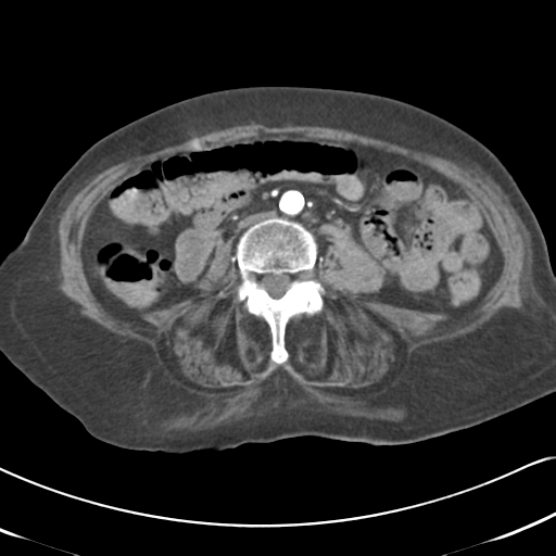 File:Active bleeding from duodenal ulcer with embolization (Radiopaedia 34216-35481 Axial C+ arterial phase 35).png