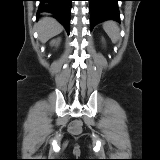 Active colonic bleed on CT (Radiopaedia 49765-55025 Coronal non-contrast 44).jpg