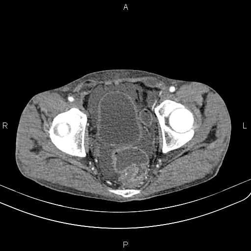 Active crohn disease (Radiopaedia 87133-103397 Axial C+ arterial phase 94).jpg