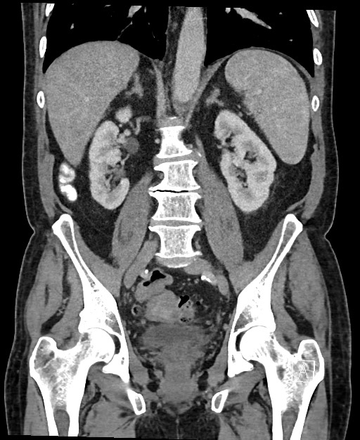 Active lower gastrointestinal bleeding - diverticular (Radiopaedia 61203-69106 Coronal C+ portal venous phase 84).jpg