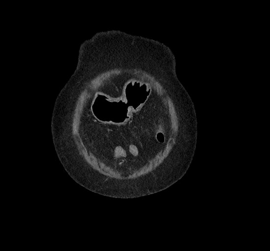 File:Active renal extravasation with large subcapsular and retroperitoneal hemorrhage (Radiopaedia 60975-68796 Coronal C+ portal venous phase 22).jpg