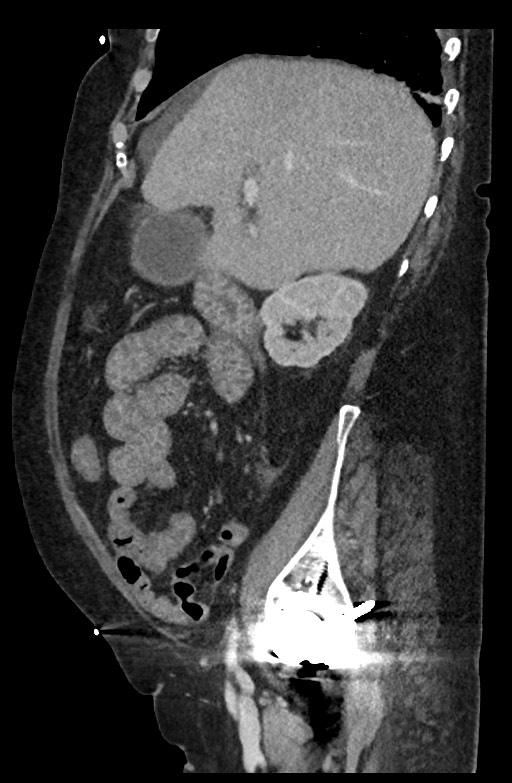 Active renal extravasation with large subcapsular and retroperitoneal hemorrhage (Radiopaedia 60975-68796 Sagittal C+ portal venous phase 157).jpg