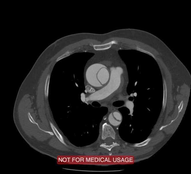Acute aortic dissection - Stanford type A (Radiopaedia 40661-43285 Axial C+ arterial phase 24).jpg