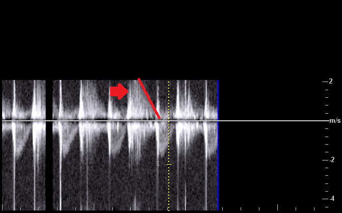 File:Acute aortic regurgitation (Radiopaedia 77174-89188 Apical 5C Colour Doppler 1).png