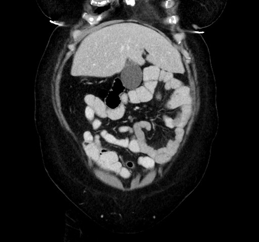 Acute appendicitis, heterotaxy syndrome (Radiopaedia 66884-76202 Coronal C+ portal venous phase 27).jpg