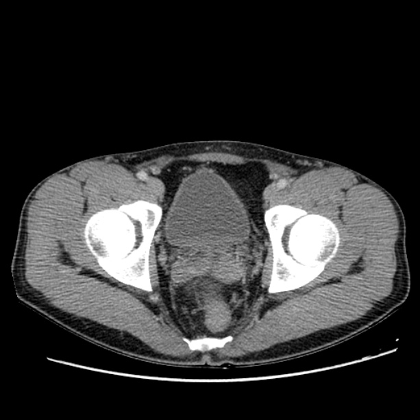 Acute appendicitis (Radiopaedia 27049-27227 Axial C+ portal venous phase 71).jpg