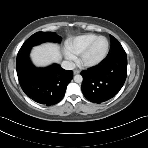 File:Acute appendicitis (Radiopaedia 30297-30934 Axial C+ portal venous phase 5).jpg