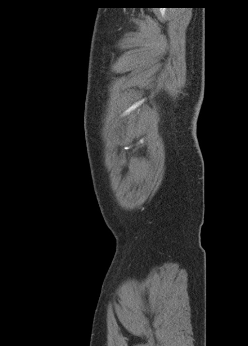 Acute appendicitis (Radiopaedia 48511-53463 Sagittal C+ portal venous phase 125).jpg