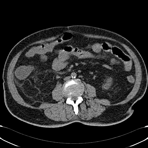 Acute appendicitis (Radiopaedia 58627-65818 Axial non-contrast 48).jpg