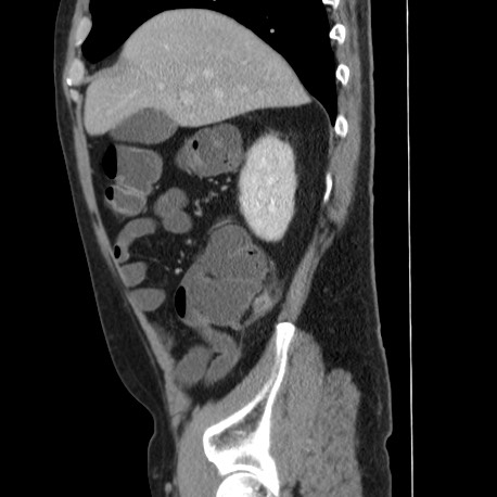 Acute appendicitis (Radiopaedia 66513-75790 Sagittal C+ portal venous phase 37).jpg