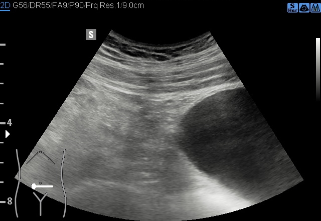 File:Acute appendicitis (Radiopaedia 85193-100745 B 176).jpg