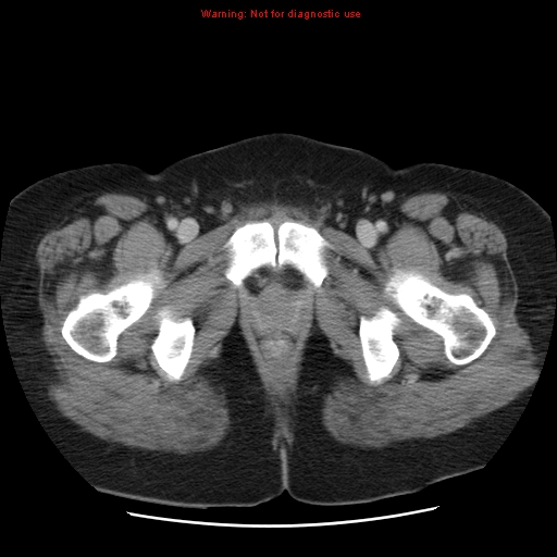 Acute appendicitis complicated by ovarian vein thrombophlebitis (Radiopaedia 16172-15851 Axial C+ portal venous phase 88).jpg
