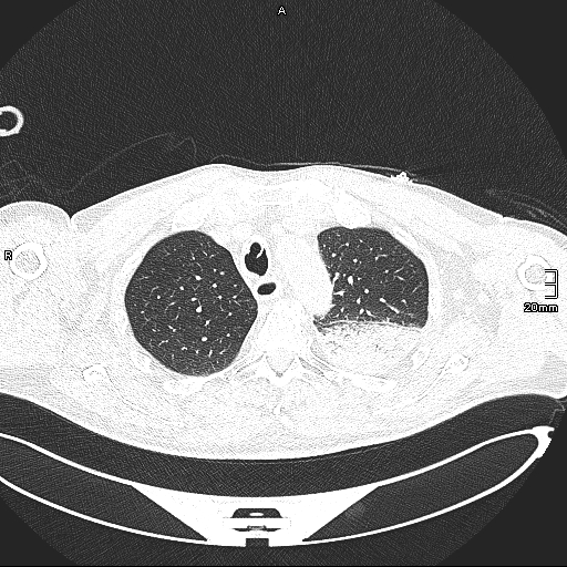 Acute aspiration pneumonitis (Radiopaedia 55642-62166 Axial lung window 42).jpg